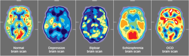 Title: Brain Scans - Description: Five brain scan images. The first is a normal brain scan, the second is a depression brain scan, the third is bipolar brain scan, the fourth is schizophrenia, and the last is an OCD brain scan.